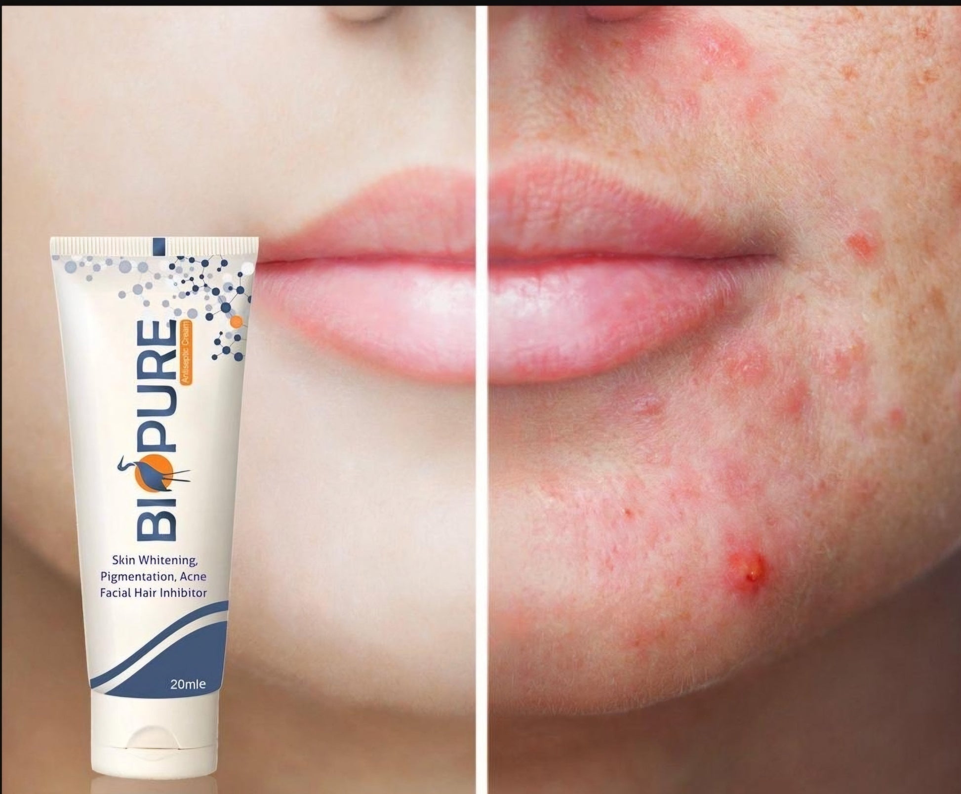 Biopure Acne Cream1